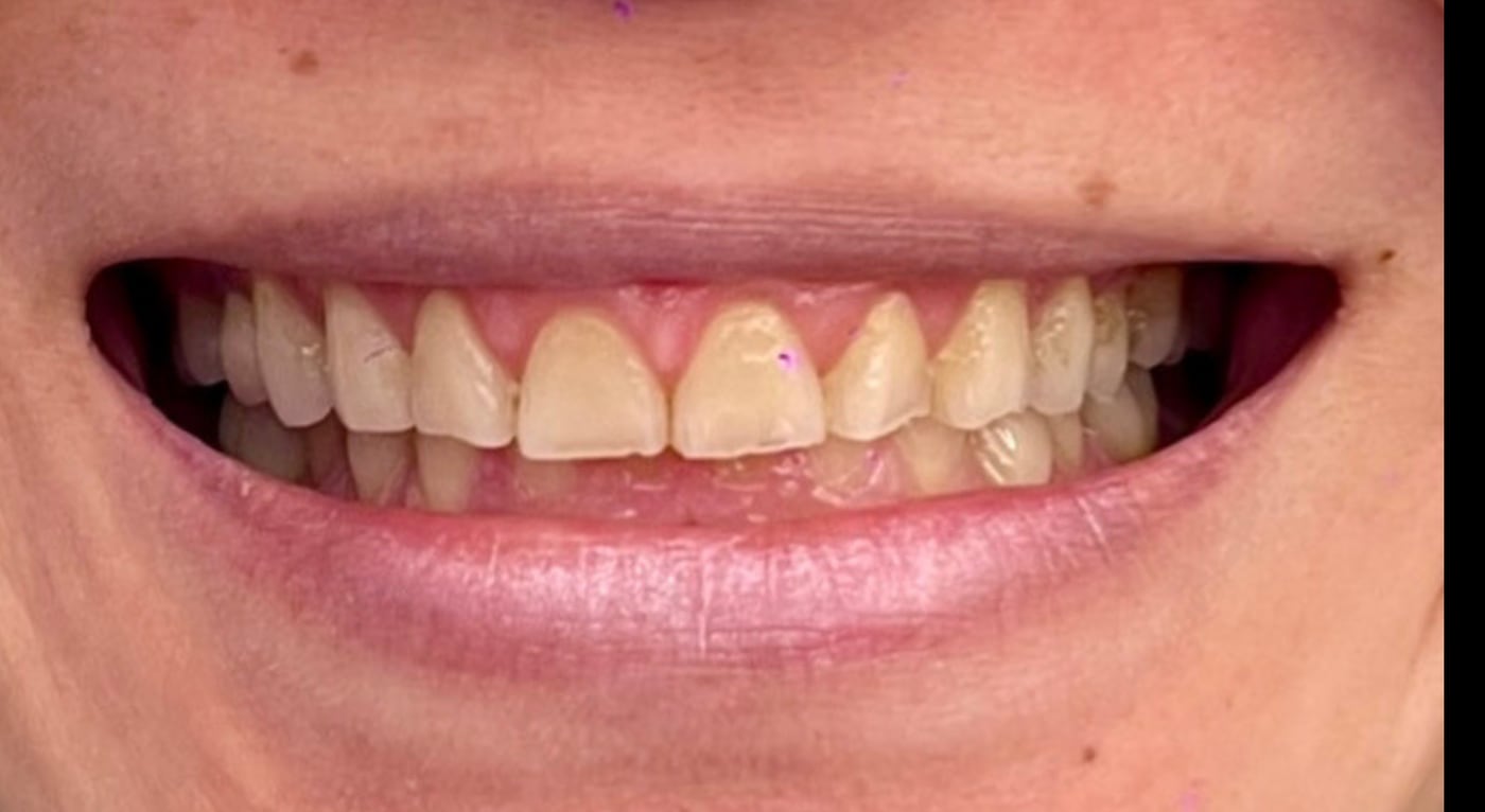 Before: biting edges worn uneven by years of stress grinding