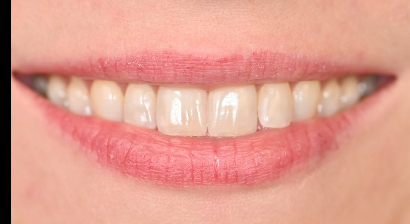 After: a brighter smile with every one of her own teeth untouched, by Dr. Peter Bonifatto, Las Vegas