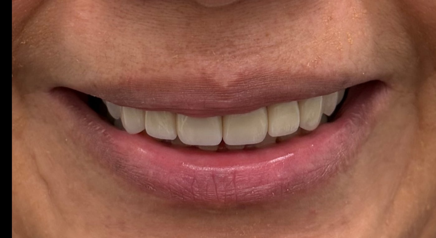 After: a complete, confident smile on a stable bite, by Dr. Peter Bonifatto, Las Vegas