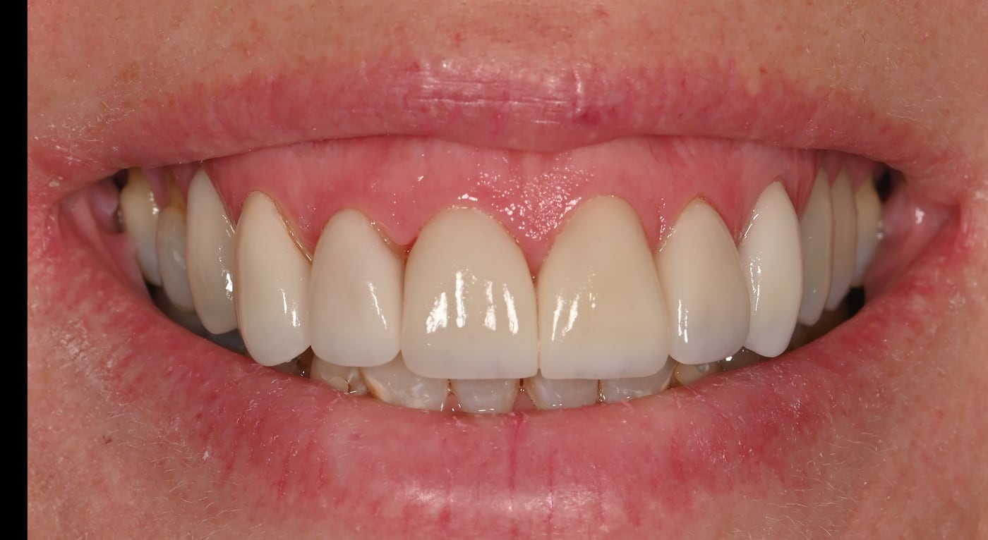 After: a healthy foundation with a brighter, balanced finish, by Dr. Peter Bonifatto, Las Vegas