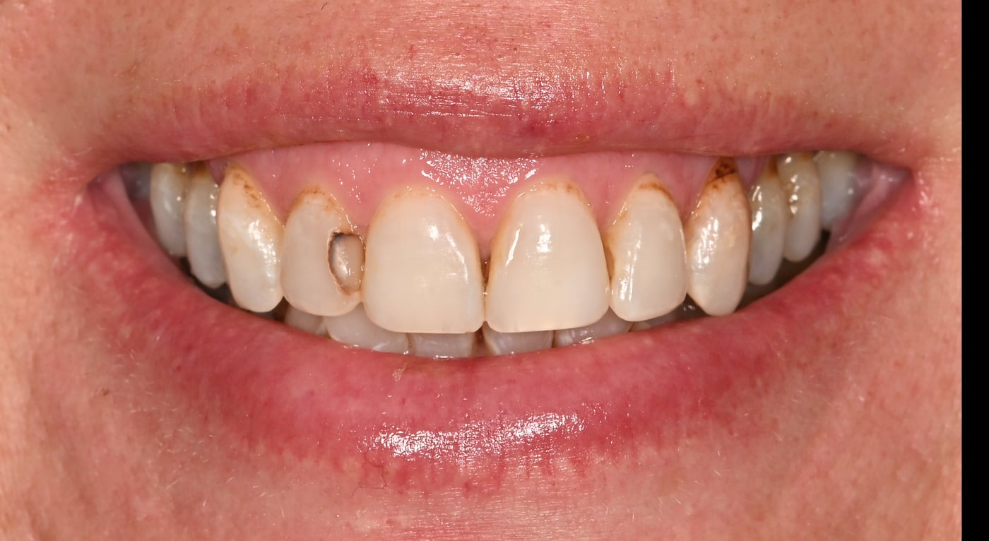 Before: resolve decay at the gumline and renew the overall look