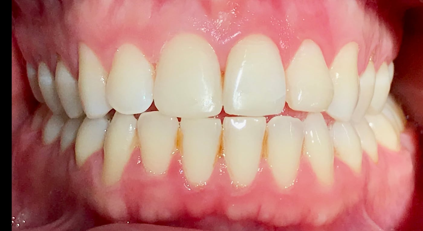 After: an invisible fix that blends completely, by Dr. Peter Bonifatto, Las Vegas