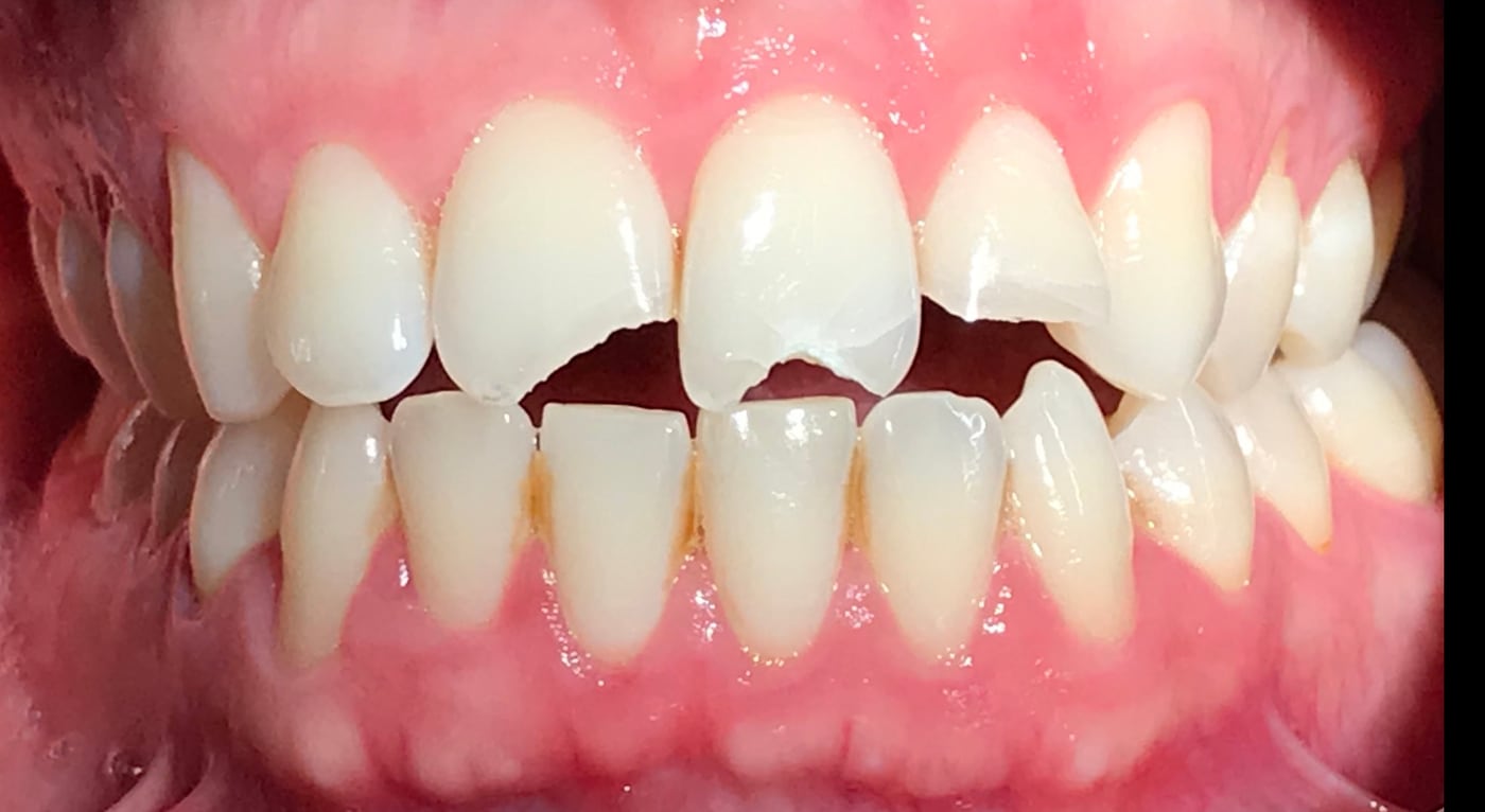 Before: repair a fractured front tooth and rebalance the edges