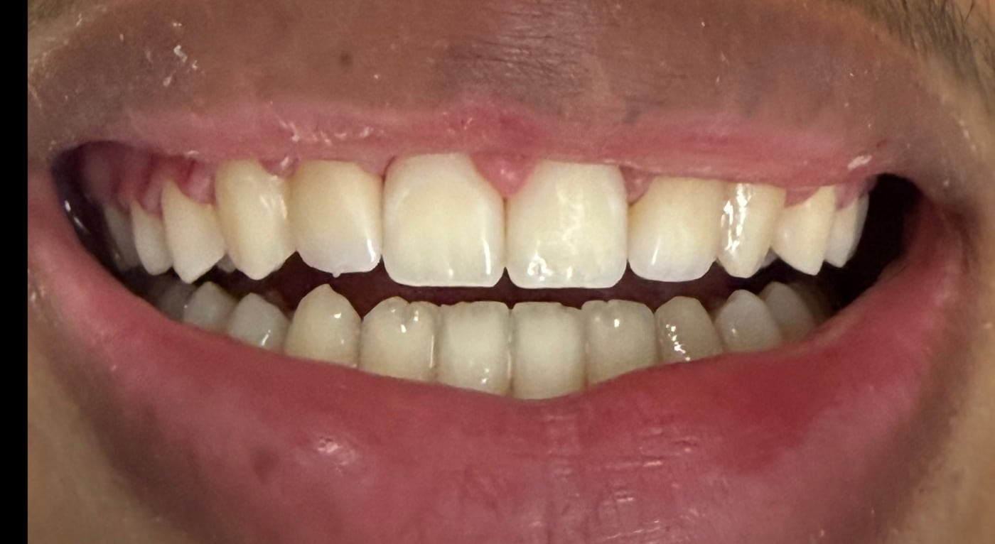 After: even proportions across the front, with his own teeth doing the rest of the work, by Dr. Peter Bonifatto, Las Vegas