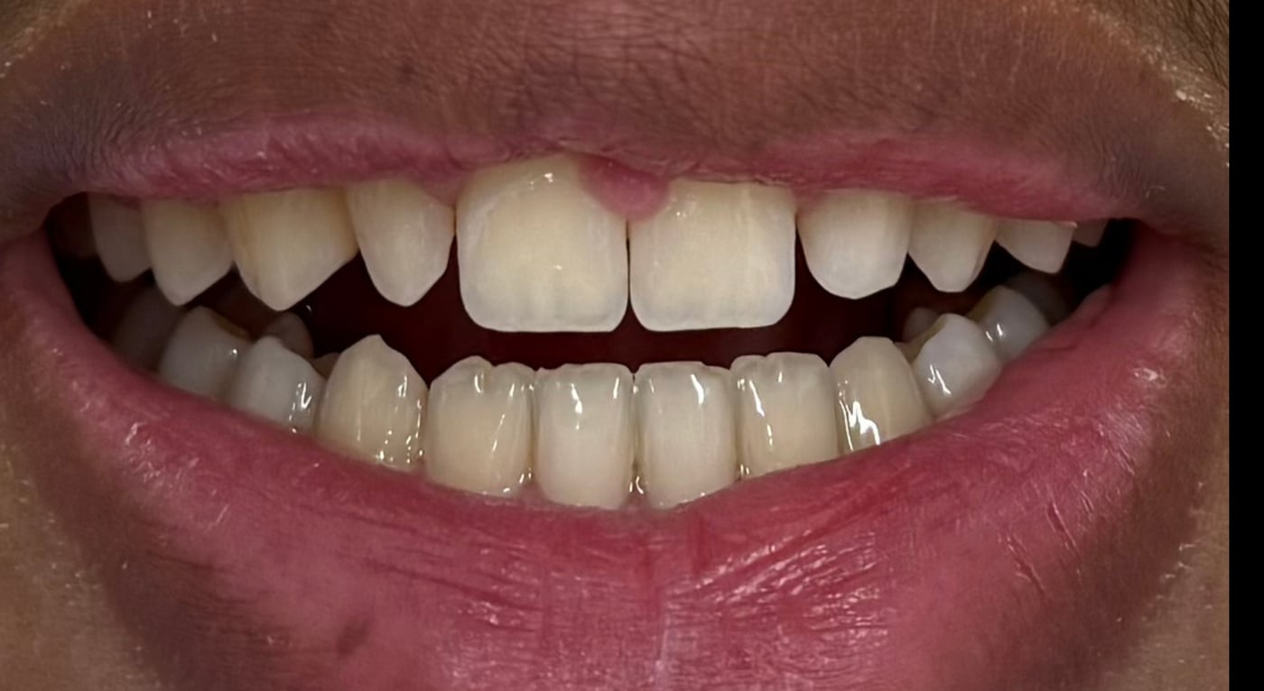 Before: two lateral incisors that stayed undersized once the braces came off