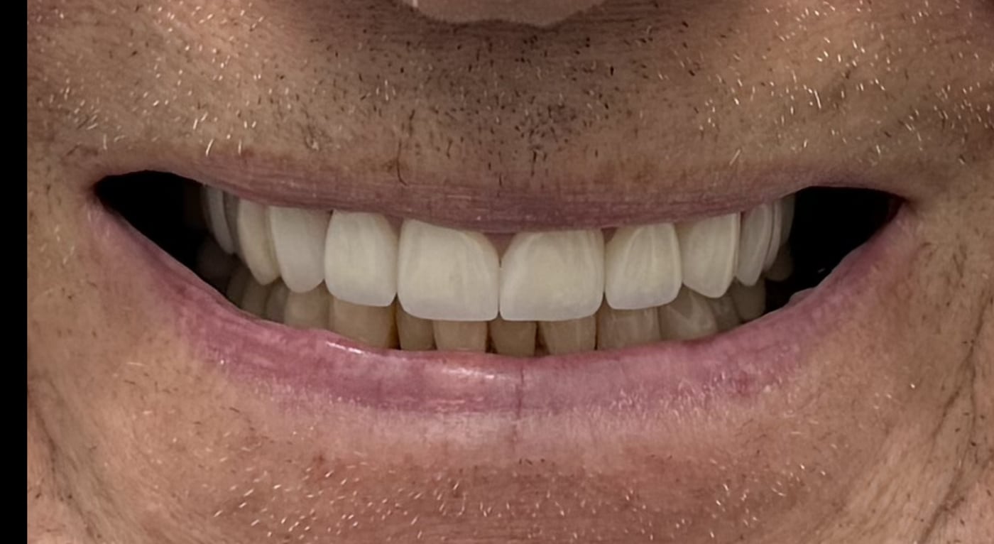 After: even length and a shade that belongs in his face, on teeth strong enough for daily load, by Dr. Peter Bonifatto, Las Vegas