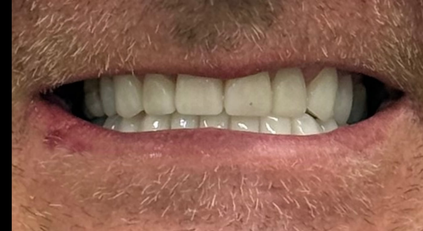 After: a clean, uniform smile built to handle daily use, by Dr. Peter Bonifatto, Las Vegas