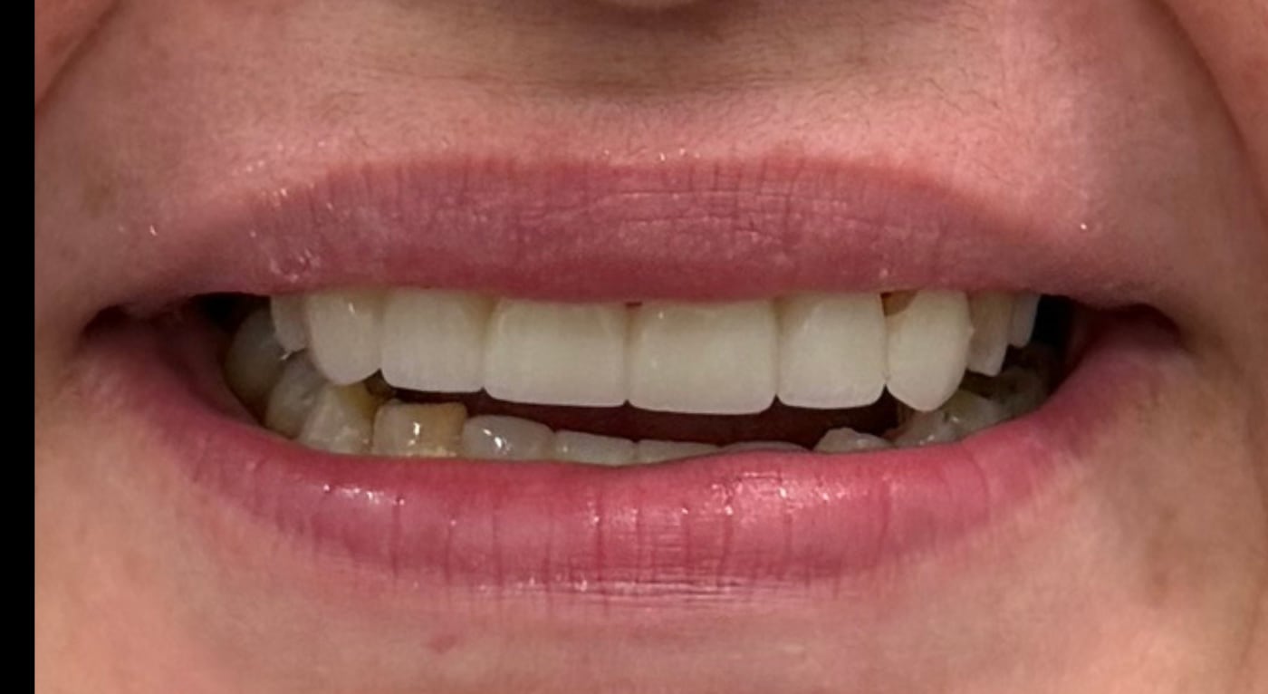 After: a stable, healthy front to the mouth built on gums that can hold it, by Dr. Peter Bonifatto, Las Vegas