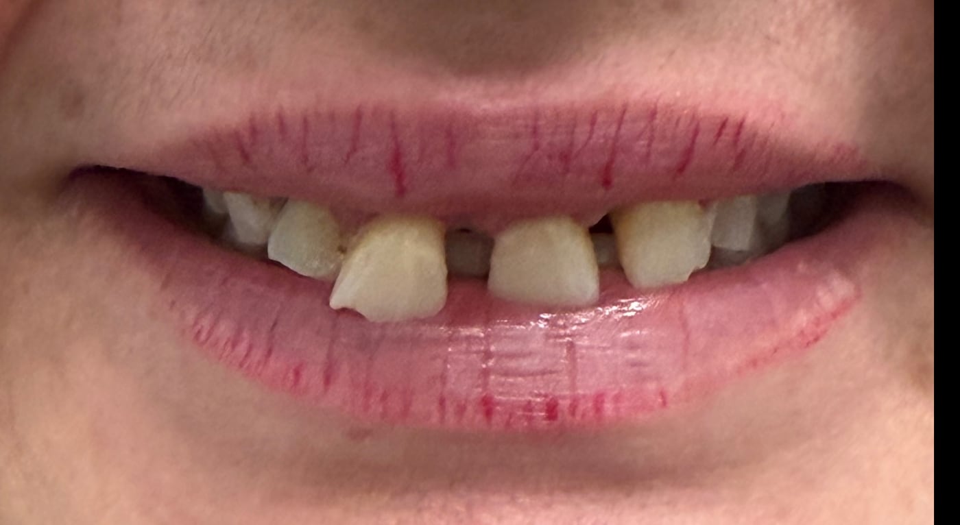 Before: advanced gum disease, with four upper front teeth that could not be saved
