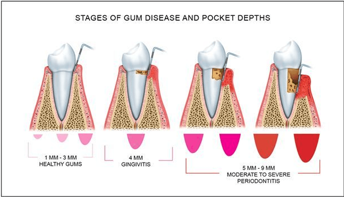 Cross-section of four teeth. In the first two the bone sits high against the tooth. In the last two the bone has dropped away and hard deposits sit deep against the root.