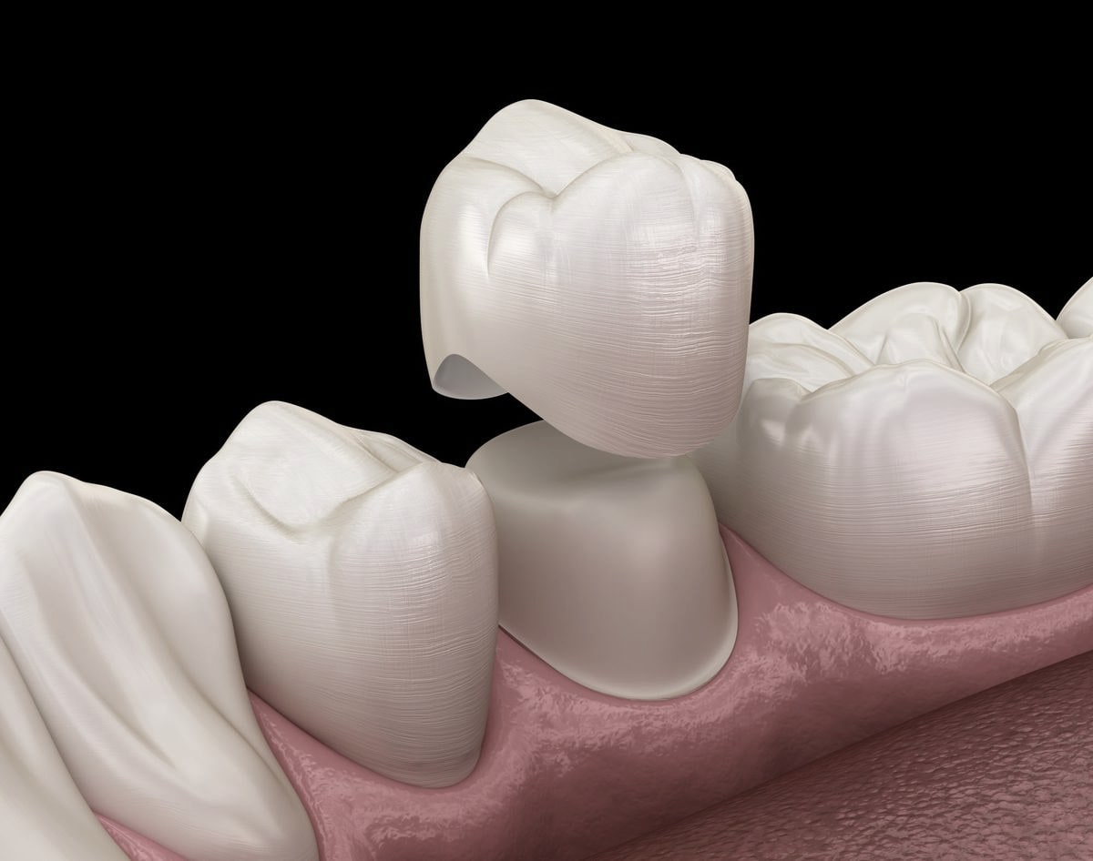Illustration of a dental crown seating over a prepared tooth