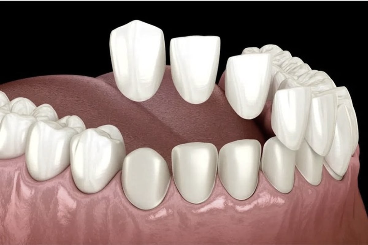 Illustration of porcelain veneers being placed onto the front surfaces of upper teeth